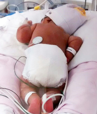 A tiny infant is shown lying down on their stomach with just a head cap and diaper along with medical tubes.