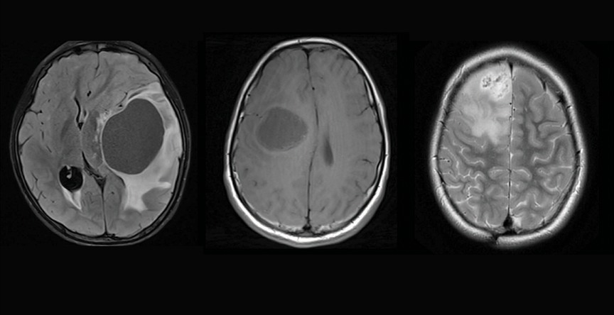Brain scan showing three different subtypes of PriMMRD high-grade glioma